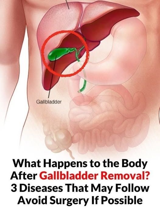After Gallbladder Removal: 3 Conditions You Could Develop