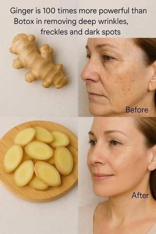 Ginger is 100 times more powerful than Botox in removing deep wrinkles, freckles and dark spots