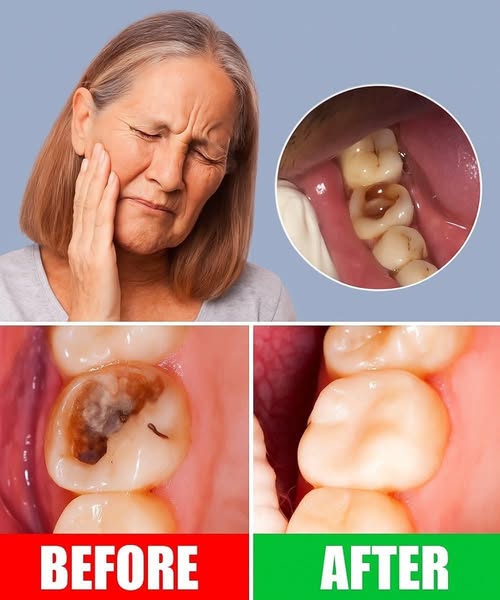 Keep these tips in mind to avoid visiting the dentist 🦷 How to naturally repair a cavity