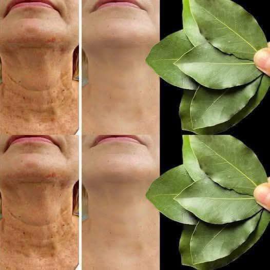 Bay leaf is 100000 times stronger than Botox. It erases all wrinkles even at the age of 70