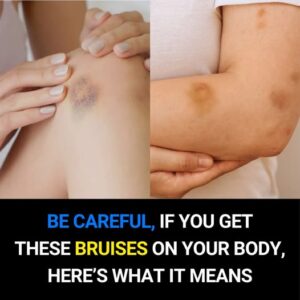 BE CAREFUL: If You Get These Bruises on&hellip;