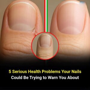 5 Silent Health Problems Your Nails Reveal Before&hellip;