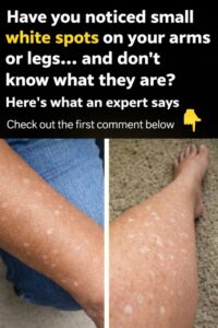 Have you noticed small white spots on your&hellip;