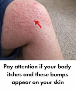 Why Do Hives Appear on the Skin? Surprising&hellip;