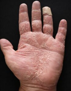 If This Appears on Your Hands, These Are&hellip;