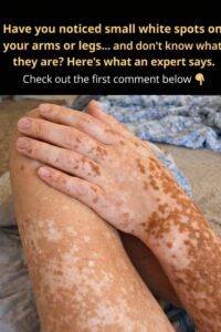 Have you noticed small white spots on your&hellip;