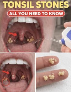 Unmasking Tonsil Stones: Effective Strategies for Fresh Breath&hellip;