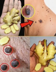 How I Gently Removed Skin Tags at Home&hellip;