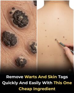 How to Remove Skin Tags and Warts Naturally&hellip;