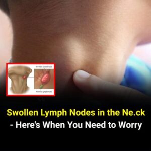 Ne.ck Swe.lling and Lymph No.des: Know When It’s&hellip;