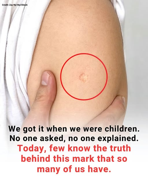 The Truth Behind the Mysterious Round Scar on the Upper Arm 