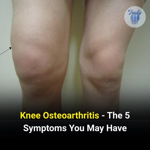 Knee Osteoarthritis: Recognize These 5 Common Symptoms Early
