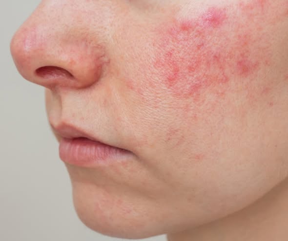 Acne. Rashes. Bug Bites. Eczema. What Your Skin Is Trying to Tell You