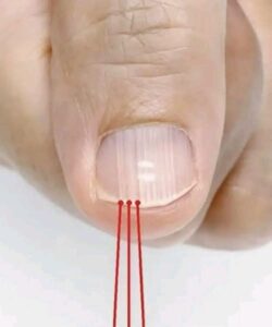  If You Have These Lines on Your Nails&hellip;