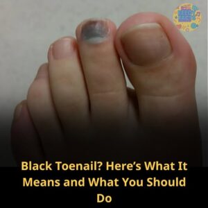 Black Toenail? Here’s What It Means — and&hellip;