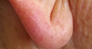  Also Called “Frank’s Sign”: Could This Ear Crease&hellip;