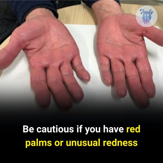 Don’t Ignore Red Palms or Unusual Redness — It Could Be a Sign Your Body Is Trying to Tell You Something 
