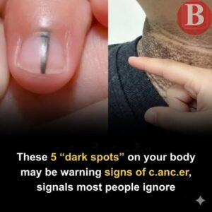 Five Unusual Dark Patches on the Body That&hellip;