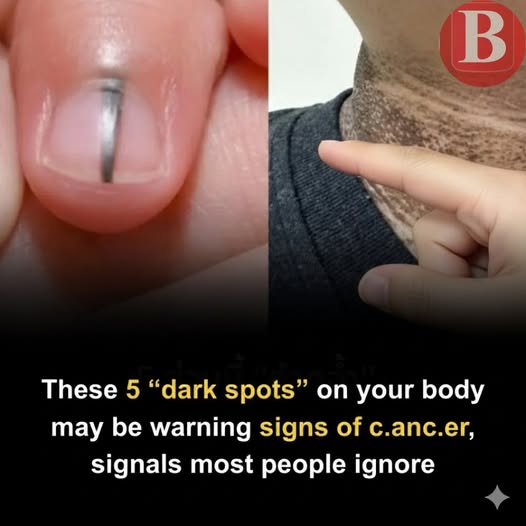 Five Unusual Dark Patches on the Body That May Signal Potential Cancer Risk 