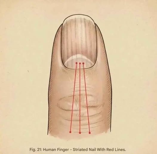  “If You Have Lines on Your Nails, It Means You Have Cancer”… Is This True?