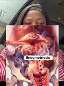 ENDOMETRIOSIS IS NOT “JUST PAIN.” It affects millions&hellip;