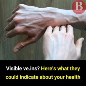 What Prominent Veins May Be Telling You About&hellip;