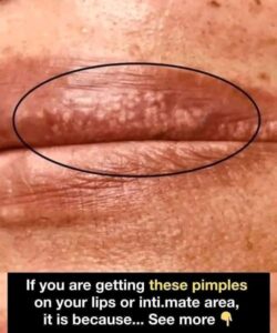  If You Are Getting Pimples on Your Lips&hellip;