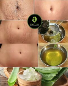  How to Get Rid of Stretch Marks Fast&hellip;
