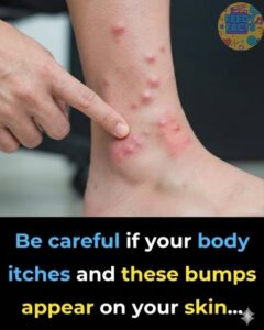  Surprising Causes of Hives Explained — What Might&hellip;