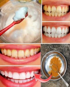  Home Teeth Whitening: Get Whiter Teeth in Just&hellip;