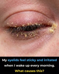 My eyelids feel sticky and irritated when I&hellip;