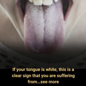  If Your Tongue Is White, It Could Be&hellip;