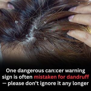  What Looks Like Dandruff May Be Something More&hellip;