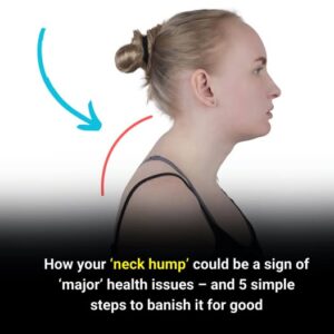  The Hidden Health Warning Behind a Neck Hump&hellip;