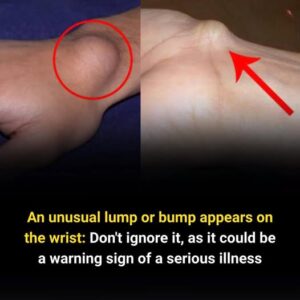  Notice an Unusual Lump on Your Wrist? Here’s&hellip;