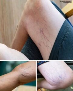  If You Have Purple Veins on Your Legs,&hellip;